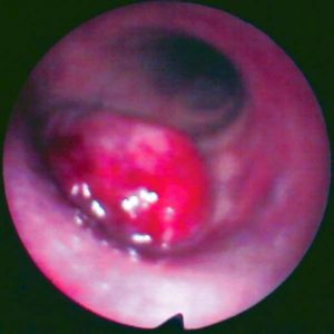 Metástasis Bronquial. Carcinoma de Células Claras