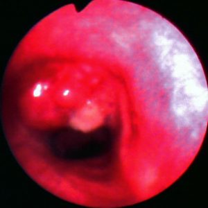 Linfoma Endobronquial