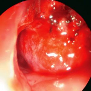 Amiloidosis Traqueal