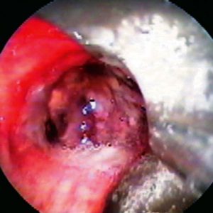 Histoplasmosis