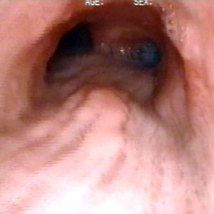 Carcinoma de Esófago