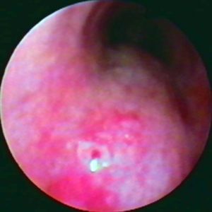 Carcinoma de Esófago