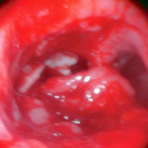 Carcinoma de Esófago