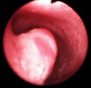 Condrosarcoma Traqueal