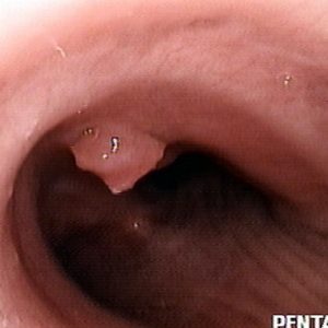 Tracheal papilloma