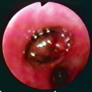 Leiomiosarcoma Bronquial
