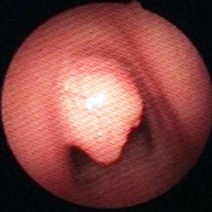 Liposarcoma Traqueal
