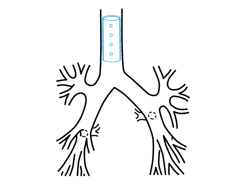 Stent Traqueal