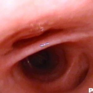 Bronquio Lobular Medio