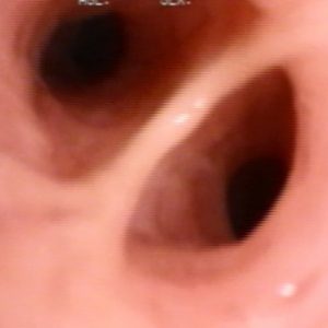 Bronquio Lobular Medio