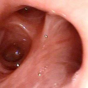 Bronquio Lobular Superior Derecho