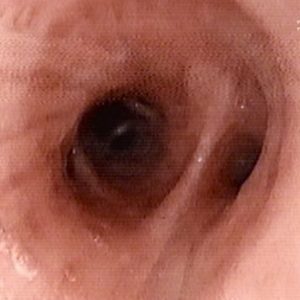 Bronquio Lobular Inferior Derecho