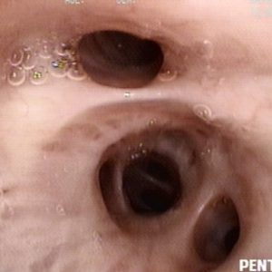 Bronquio Lobular Inferior Derecho