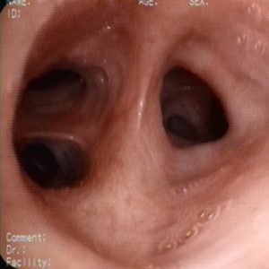 Bronquio Lobular Medio