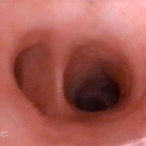 Bronquio Lobular Superior Izquierdo