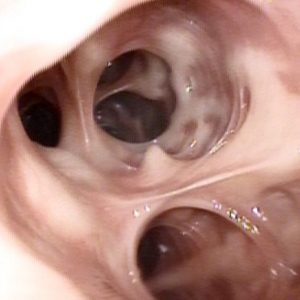 Atrofia de la Mucosa Bronquial