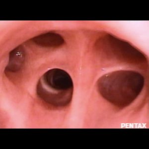 Bronquio Lobular Superior Derecho