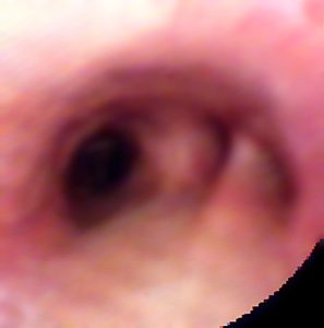 Bronquio Lobular Inferior Derecho