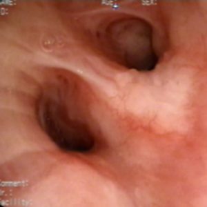 Rugosidad de la Mucosa