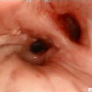 Protrusión Submiliar