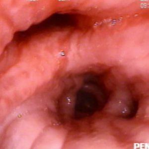 Edema de Mucosa