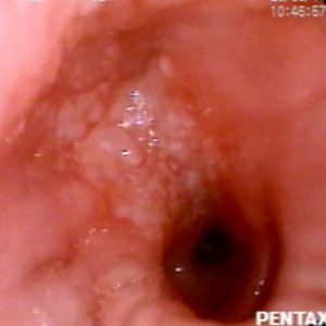 Carcinoma Bronquial