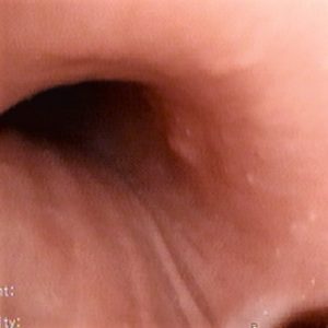 Protrusión Submucosa