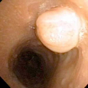 Granuloma