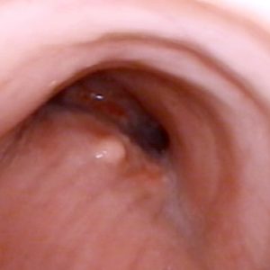 Protrusión Submucosa