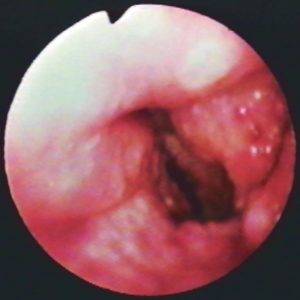 Tuberculosis Laríngea