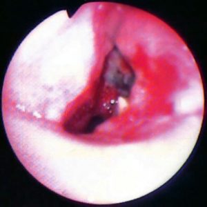 Fistula Gangliobrónquica