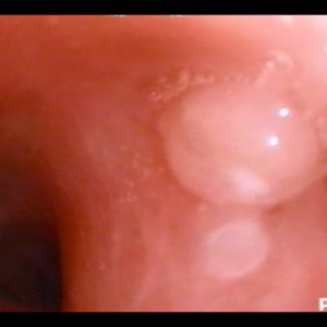 Fistula Gangliobrónquica