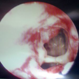 Aspergilosis Cavitaria