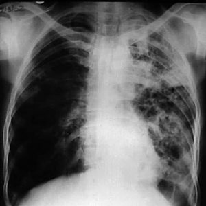 Broncoscopía en las cavidades pulmonares