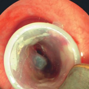 Stent en Estenosis Traqueal