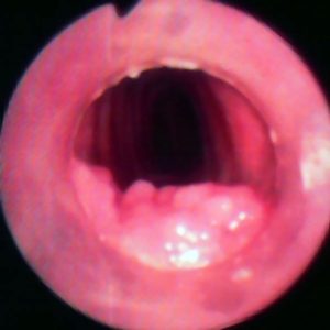 Granuloma Por Contacto
