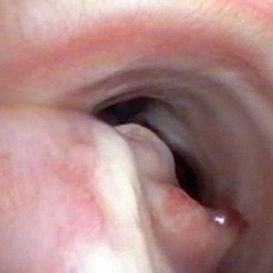 Granuloma Traqueal