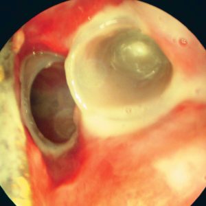Doble Stent en Carcinoma