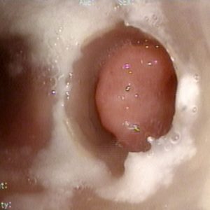Stents y estenosis