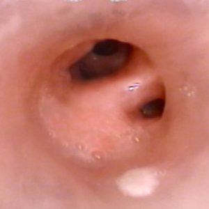 Stent Bronquial