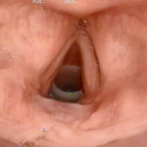 Estenosis Subglótica