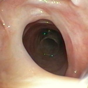 Migración de Stent Traqueal