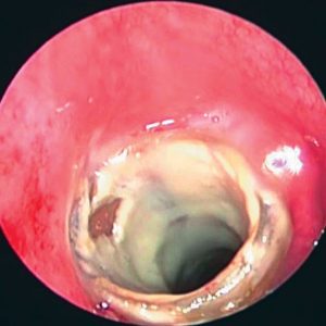 Stent Bronquial. Incrustación de Secreciones