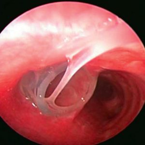 Stent Bronquial. Secreción Filante