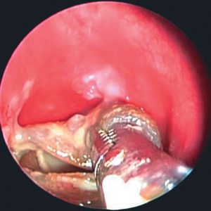 Remoción de Stent