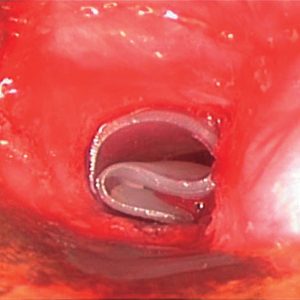 Stent en Omega