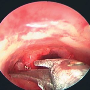 Corte de Stent