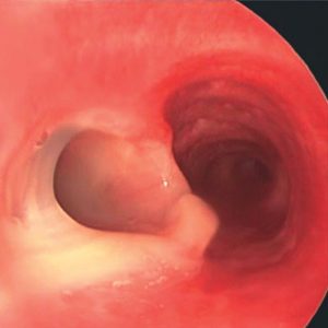 Stent Bronquial. Secreciones