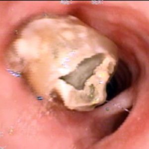 Stent Traqueal. Incrustación de Secreciones