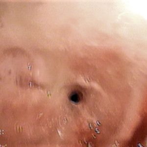 Estenosis Bronquial